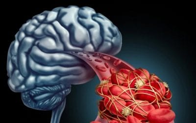 Un ataque de ACV mata 2 millones de neuronas por minuto