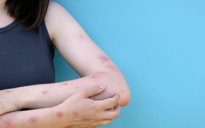 ¿Dermatitis atópica?