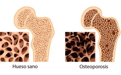 La osteoporosis afecta a 10 millones de mexicanos