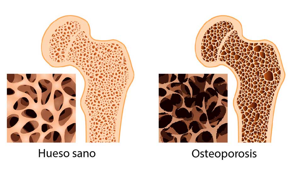La osteoporosis afecta a 10 millones de mexicanos