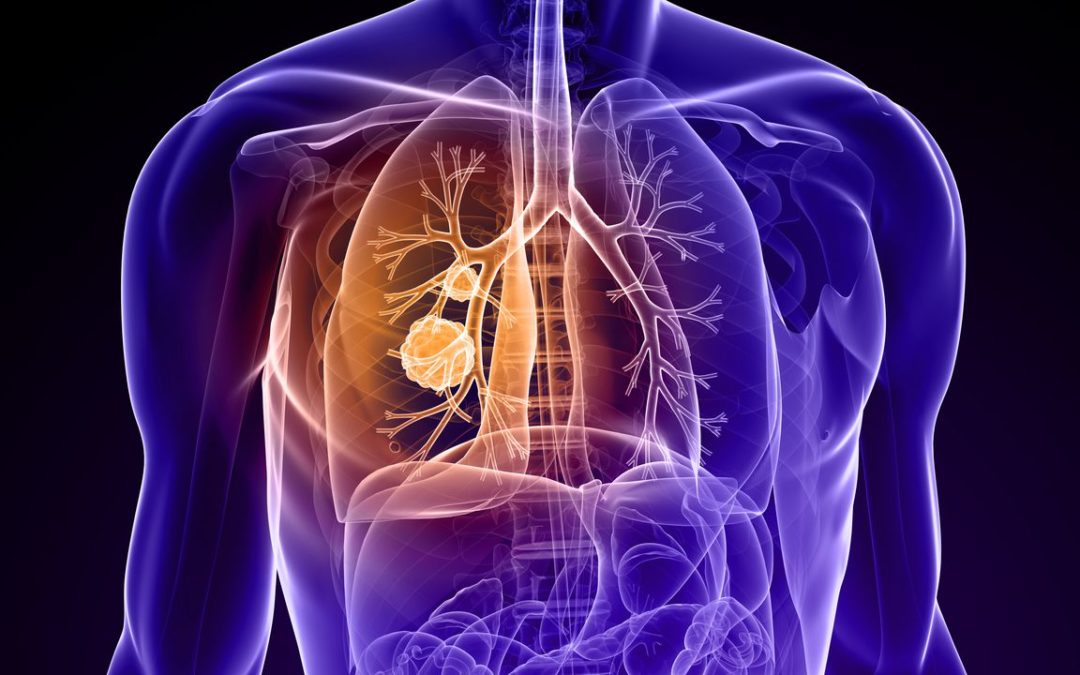 Estos son los síntomas que anuncian un cáncer de pulmón