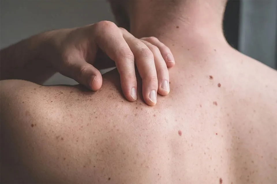 Cuidado de la piel: 5 sugerencias para una piel sana